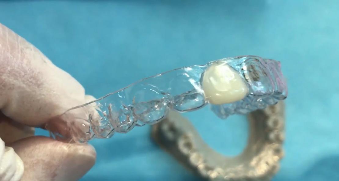 Gouttière de contention orthodontique dans l